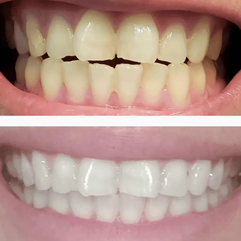 Kit Clareador Dental SNOW Diamond Series com Luz LED